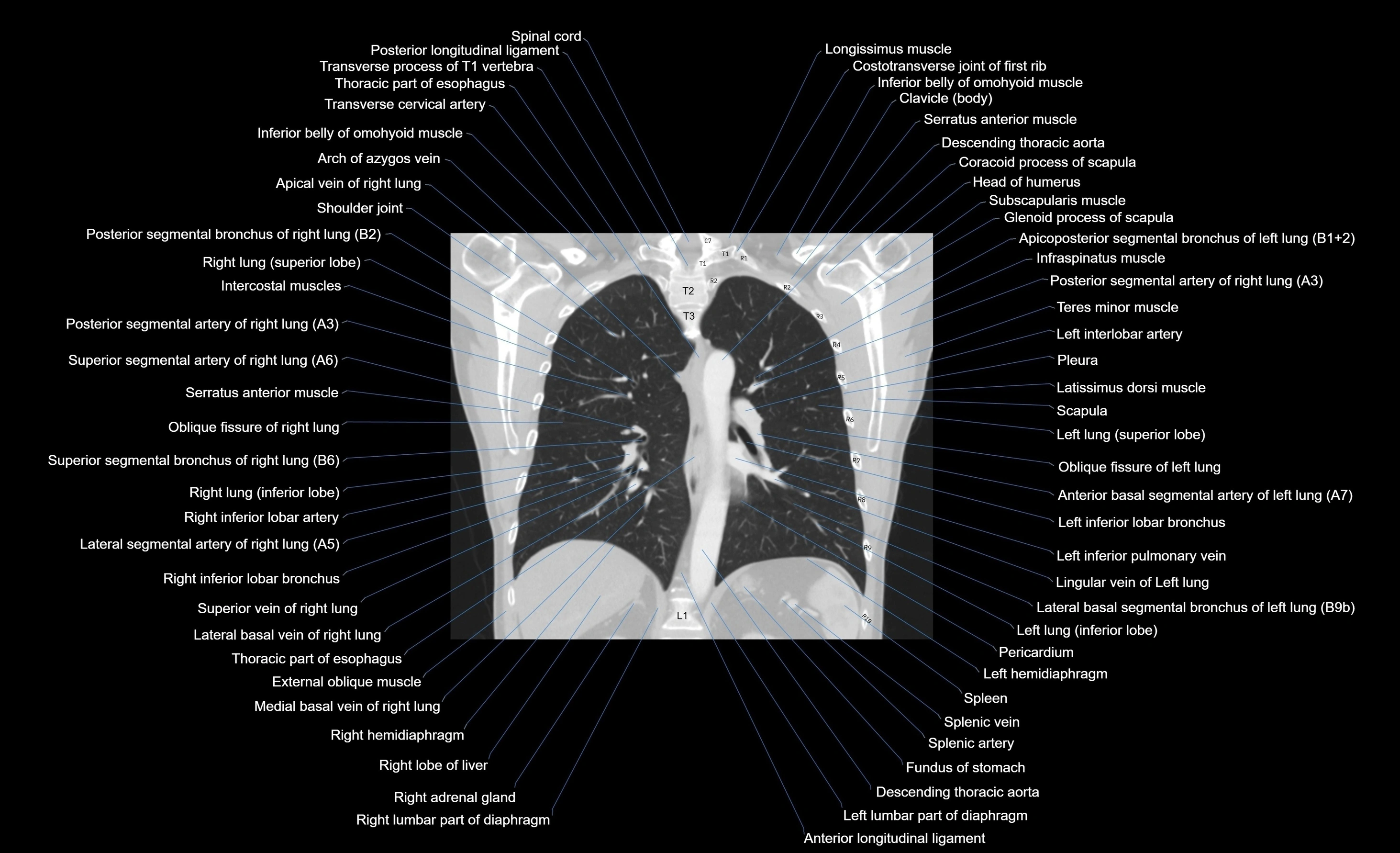 CT chest (thorax) labelled coronal cross sectional anatomy radiology image-00050.webp